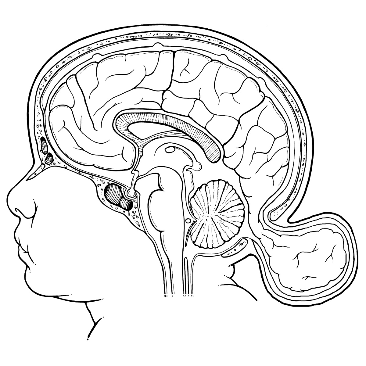 Encephalocele